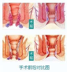 內(nèi)痔術(shù)前與術(shù)后對比圖